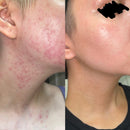 Gel Adapaleno Medley Para Tratamento de Acne